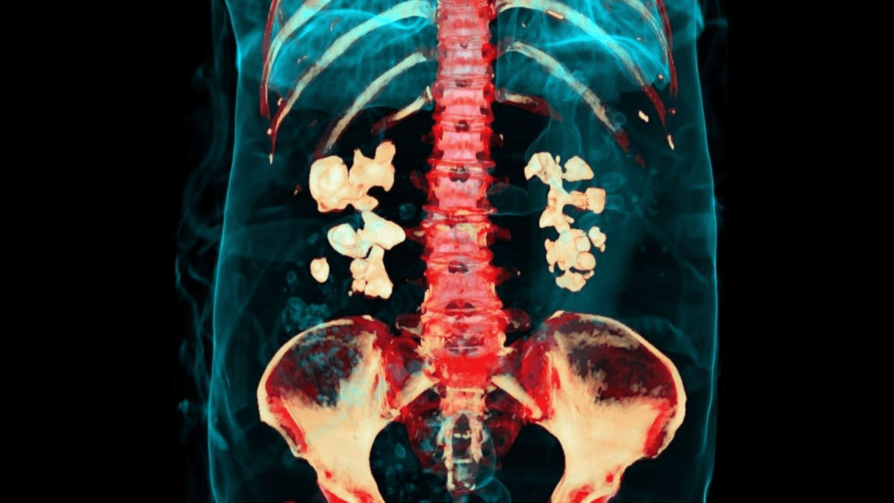 Bacteria Play Previously Unknown Role in Kidney Stones, Study Finds